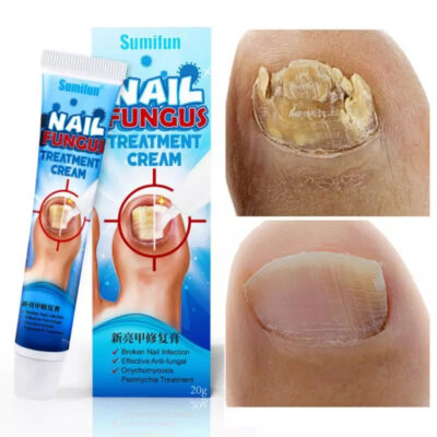 Nail Fungus Treatment Cream | Herbal Ointment for Fungal and Discolorated Nails