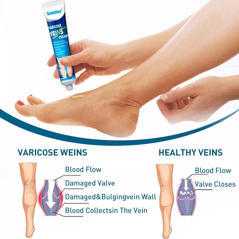Varicose Veins Cream | Herbal Cream for Spider Veins and Varicose Veins - Image 4
