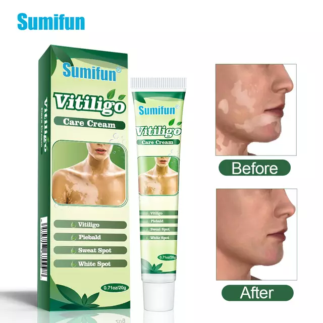 Vitiligo Care Cream | Topical Ointment for White Spots, Piebald, and Vitiligo - Image 6