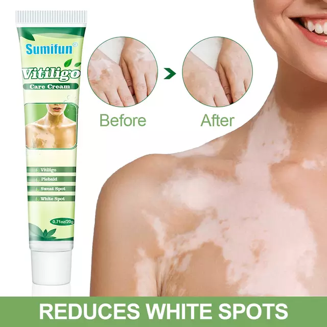 Vitiligo Care Cream | Topical Ointment for White Spots, Piebald, and Vitiligo - Image 7