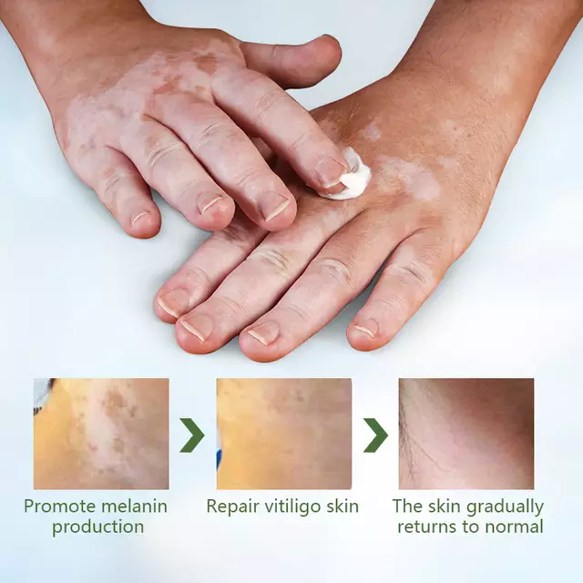 Vitiligo Care Cream | Topical Ointment for White Spots, Piebald, and Vitiligo - Image 14
