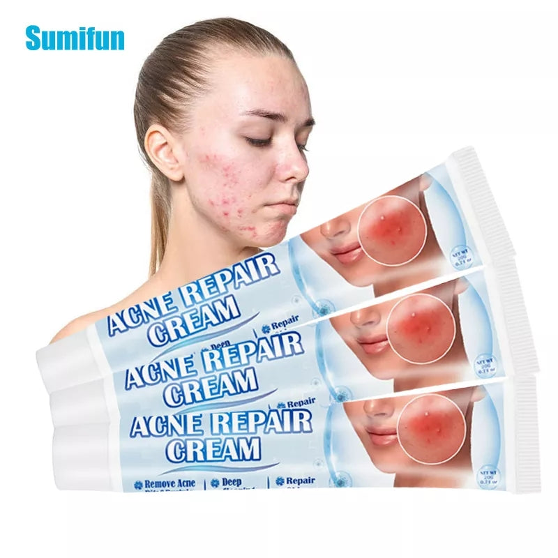 Acne Repair Cream | Herbal Ointment for Pimples, Acne Marks, Postules, and Blackheads - Image 8