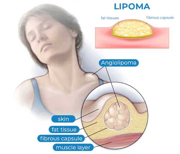 Lipoma Cream | Herbal Ointment for Skin Lump, Benign Lipoma and Tumor - Image 14