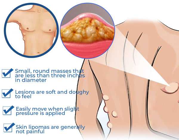Lipoma Cream | Herbal Ointment for Skin Lump, Benign Lipoma and Tumor - Image 12