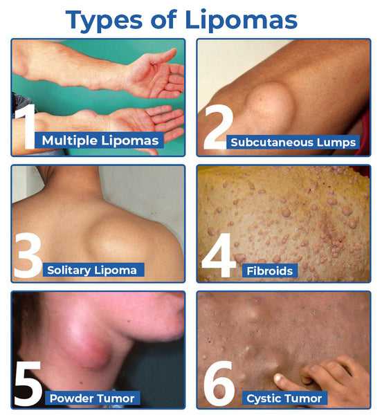 Lipoma Cream | Herbal Ointment for Skin Lump, Benign Lipoma and Tumor - Image 11