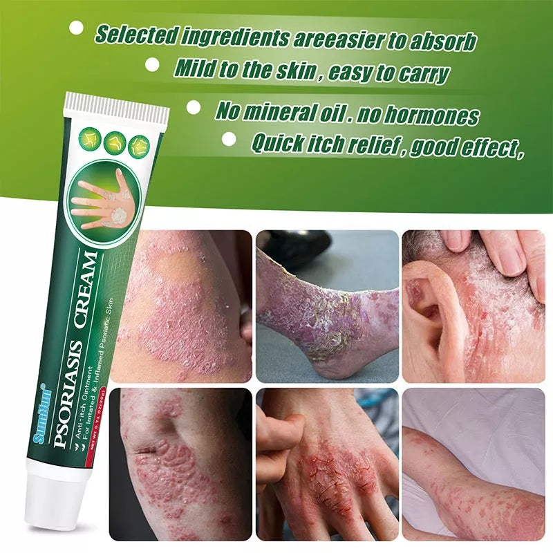 Psoriasis Cream | Herbal Cream for Psoriasis, Dermatitis, Eczema, and Itching - Image 2