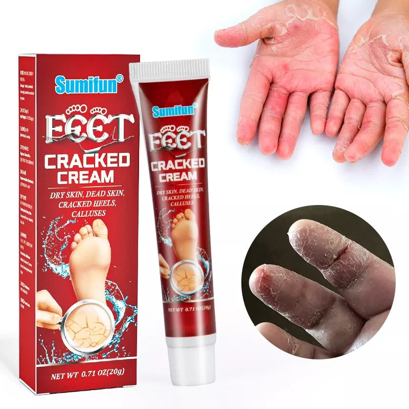 Cracked Hands and Feet Cream | Skin Ointment for Cracked Heels, Dry Skin and Dead Skin - Image 4