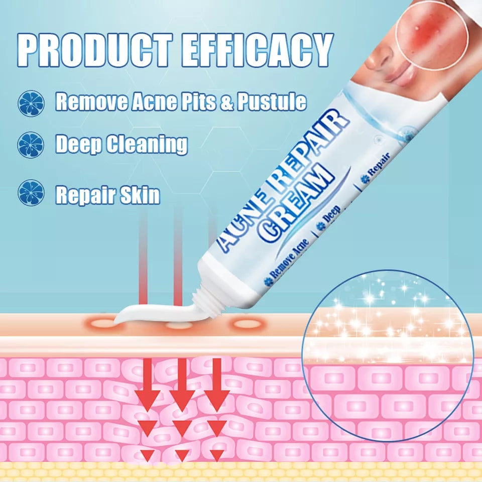 Acne Repair Cream | Herbal Ointment for Pimples, Acne Marks, Postules, and Blackheads - Image 7