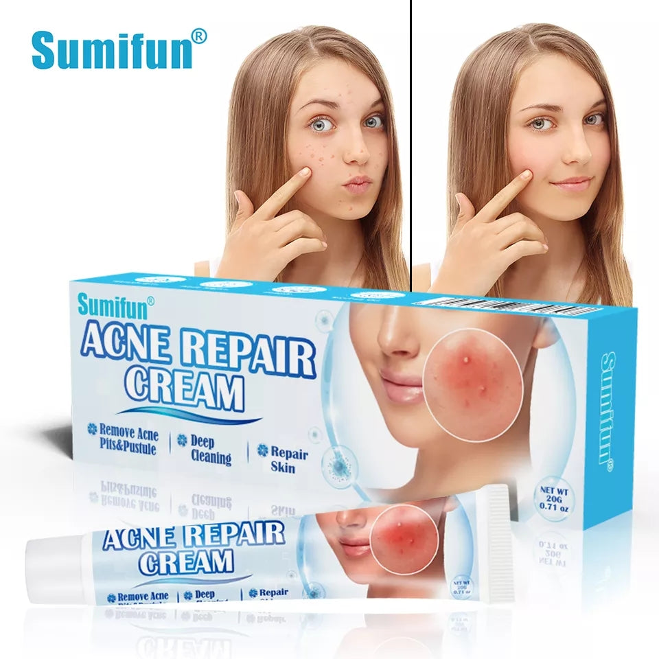 Acne Repair Cream | Herbal Ointment for Pimples, Acne Marks, Postules, and Blackheads - Image 4