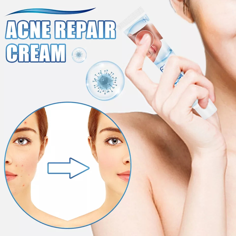 Acne Repair Cream | Herbal Ointment for Pimples, Acne Marks, Postules, and Blackheads - Image 5