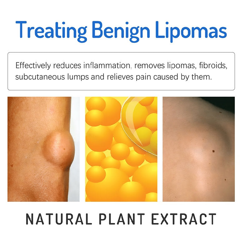 Lipoma Cream | Herbal Ointment for Skin Lump, Benign Lipoma and Tumor - Image 8