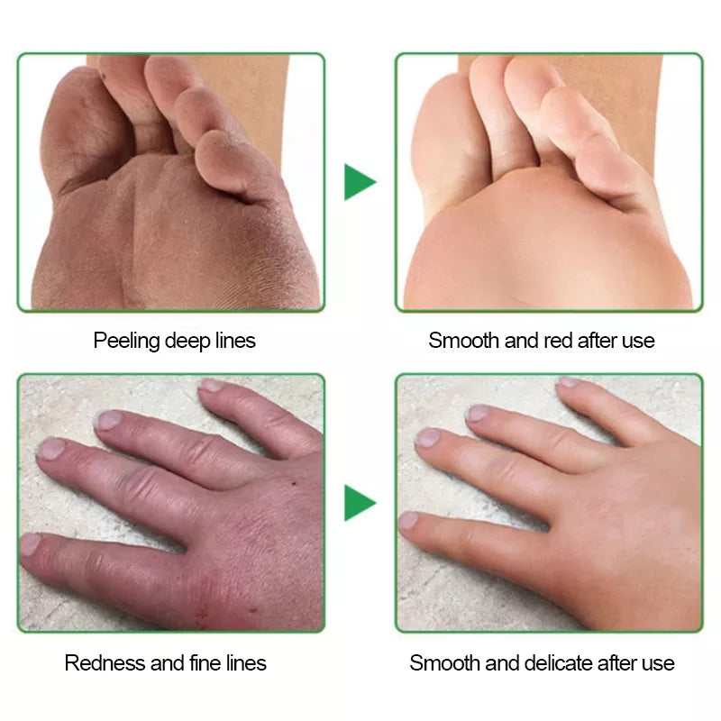 Cracked Hands and Feet Cream | Skin Ointment for Cracked Heels, Dry Skin and Dead Skin - Image 11