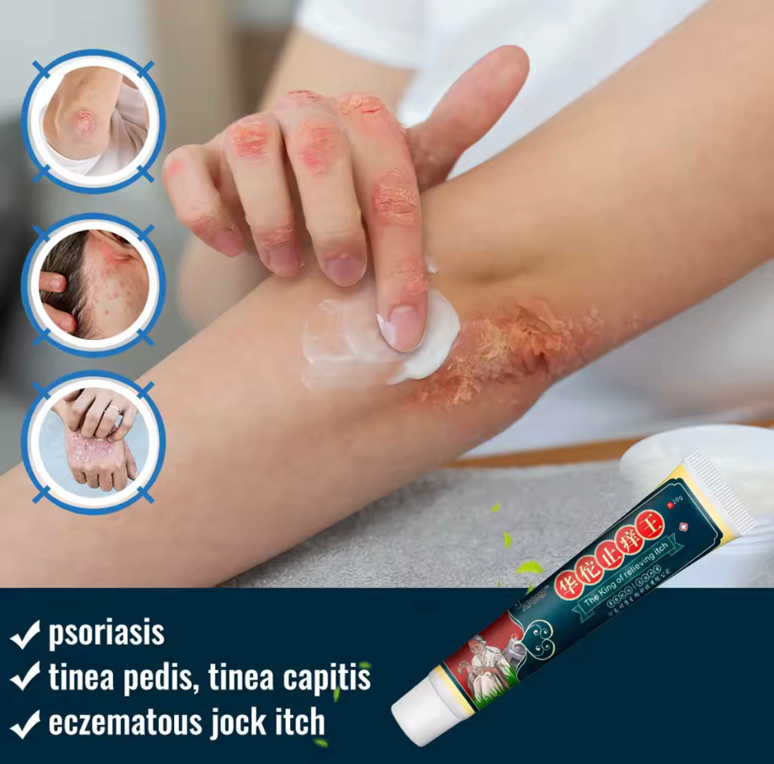 APGMA The King of Relieving Itch Cream | Topical Cream for Psoriasis, Dermatitis, Eczema, Tinea, and Folliculitis - Image 3