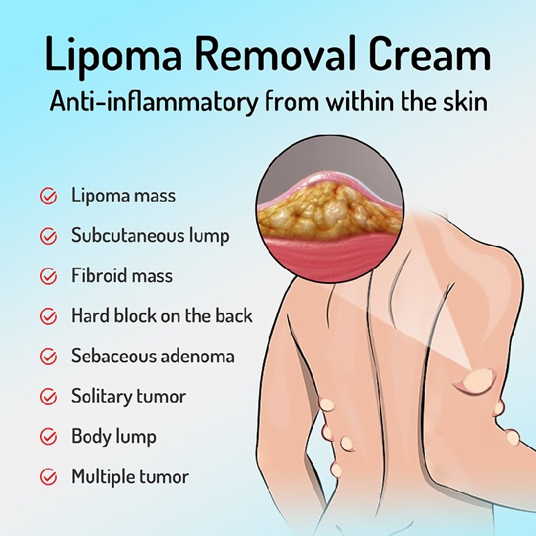 Lipoma Cream | Herbal Ointment for Skin Lump, Benign Lipoma and Tumor - Image 10