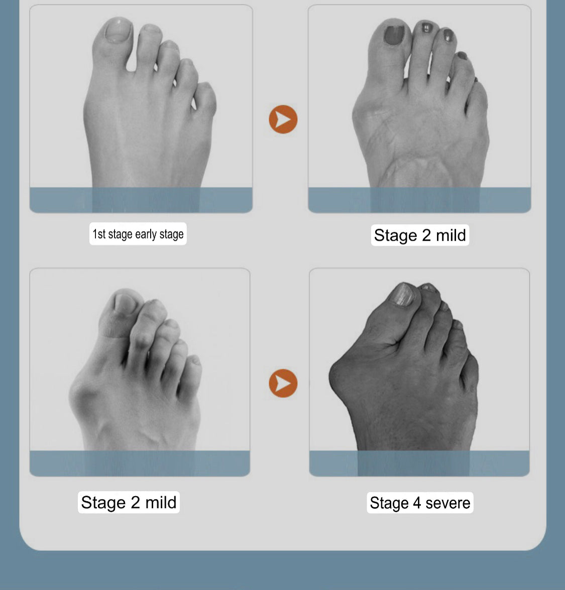 Bunion Corrector | Hallus Valgus Corrector | Orthopedic Bunion Splint - Image 7