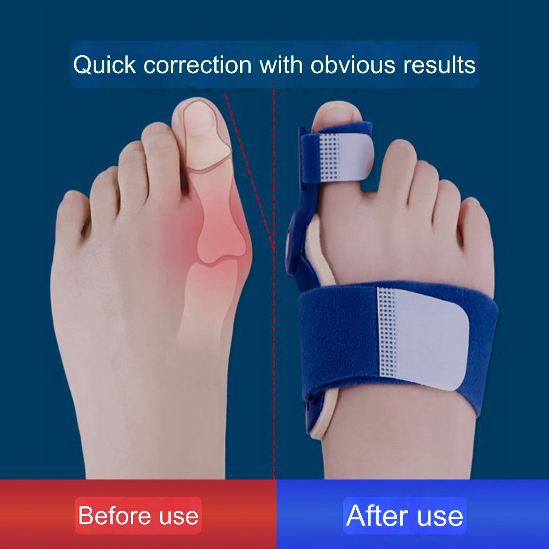 Bunion Corrector | Hallus Valgus Corrector | Orthopedic Bunion Splint - Image 6