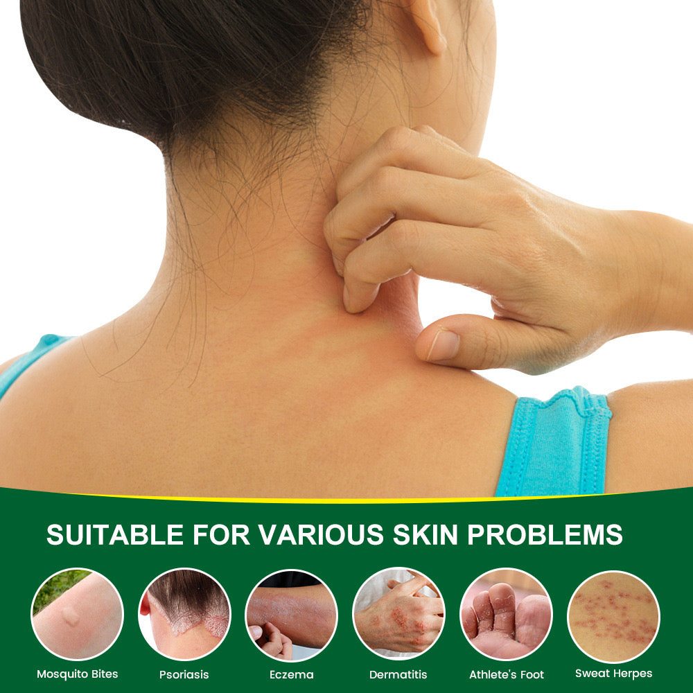 Anti-Itching Cream | Topical Remedy for Mosquito Bites, Psoriasis, Eczema, Dermatitis, and Sweat Herpes - Image 2