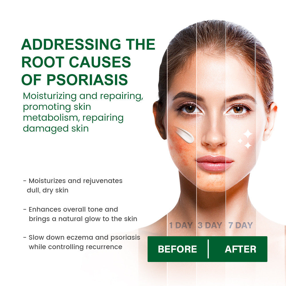 Anti-Itching Cream | Topical Remedy for Mosquito Bites, Psoriasis, Eczema, Dermatitis, and Sweat Herpes - Image 3