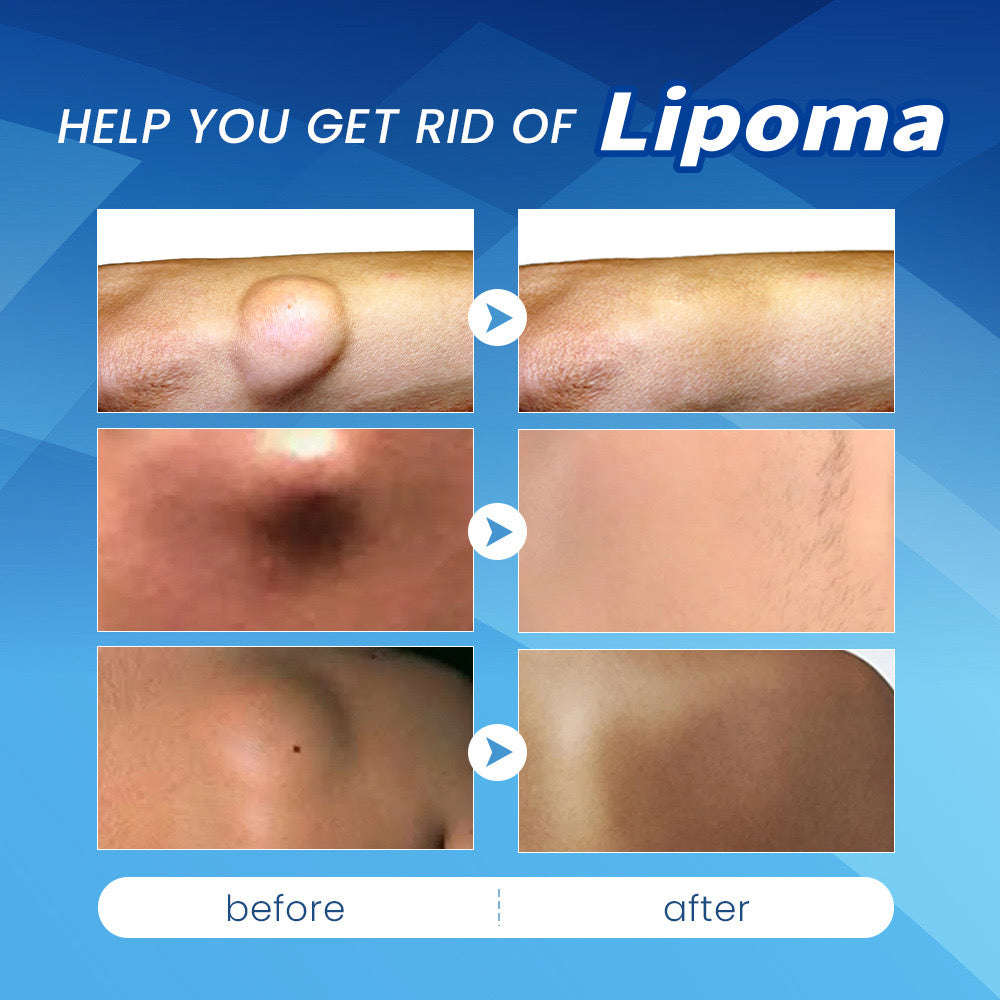 Lipoma Relief Patch - Image 4