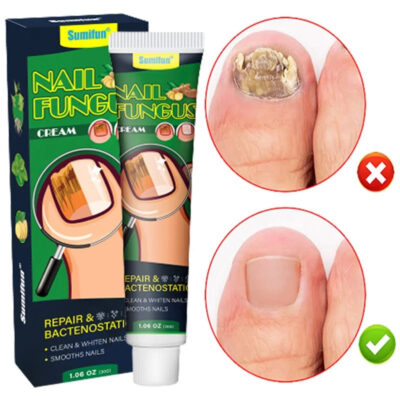 Nail Fungus Treatment Cream