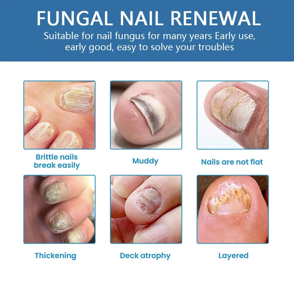 Nail Fungus Relief Spray | Topical Spray for Infected, Damaged and Discolored Nails - Image 2