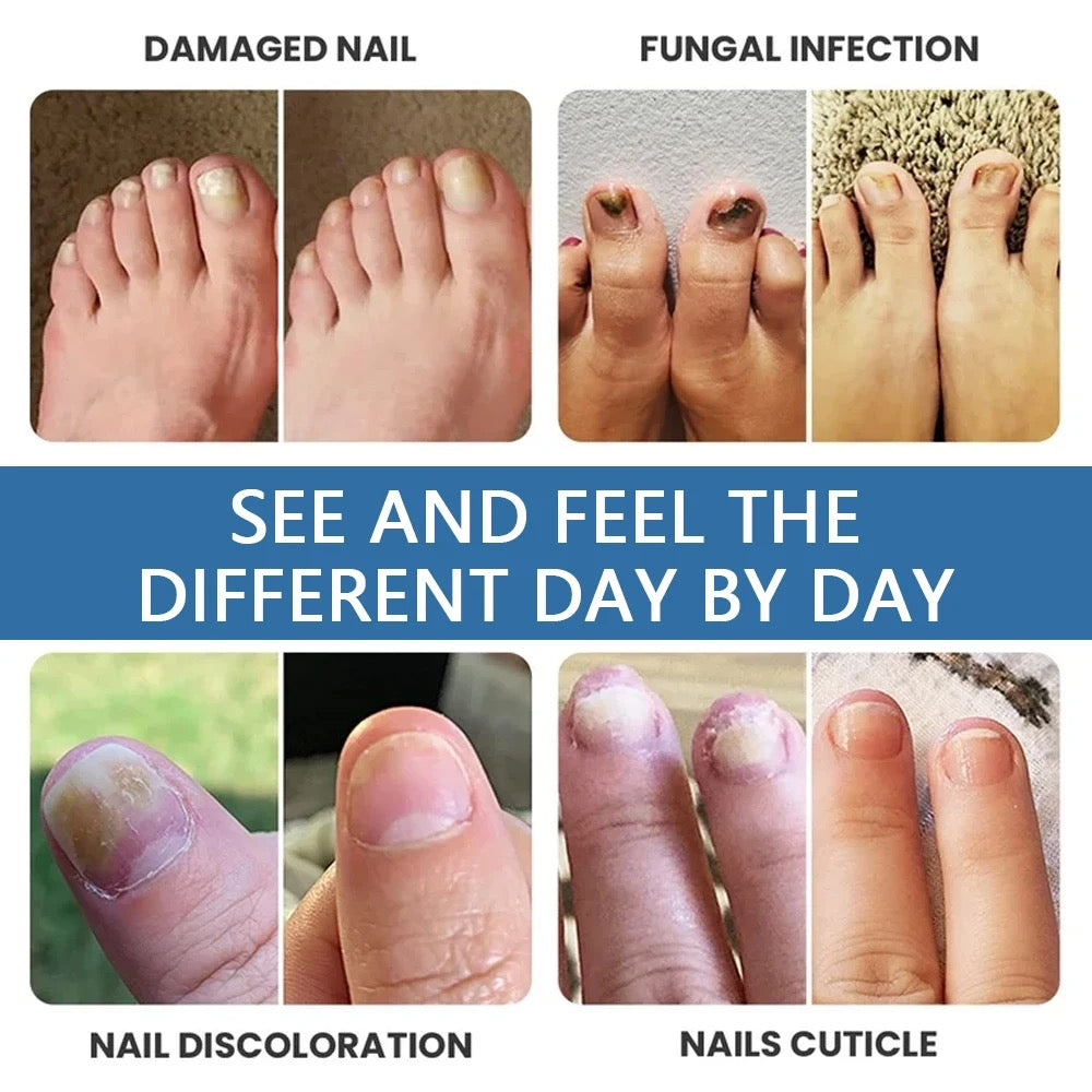 Nail Fungus Relief Spray | Topical Spray for Infected, Damaged and Discolored Nails - Image 8