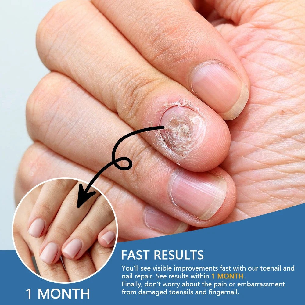 Nail Fungus Relief Spray | Topical Spray for Infected, Damaged and Discolored Nails - Image 9