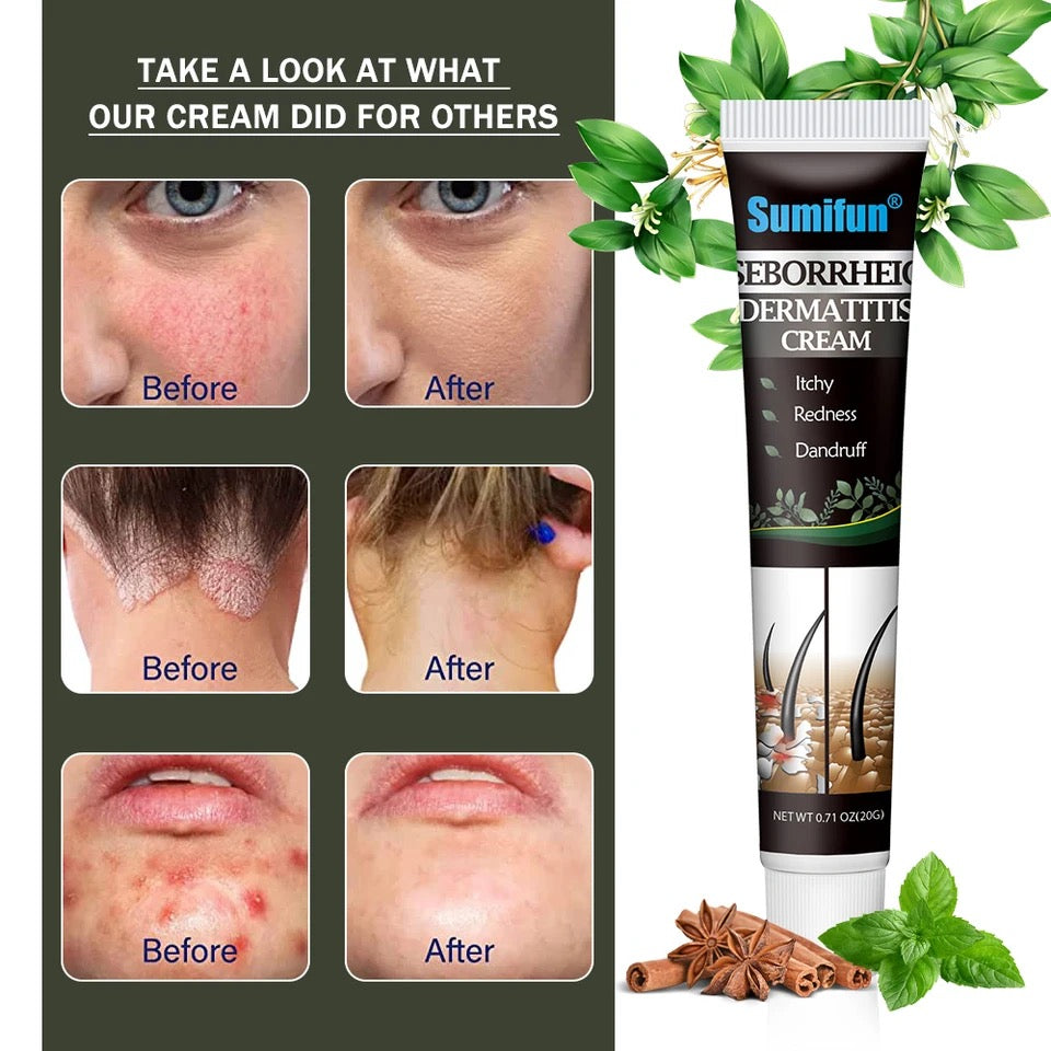 Seborrheic Dermatitis Cream | Herbal Cream for Treating Dermatitis, Psoriasis, and Dandruff - Image 3