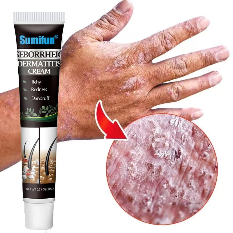 Seborrheic Dermatitis Cream | Herbal Cream for Treating Dermatitis, Psoriasis, and Dandruff - Image 9