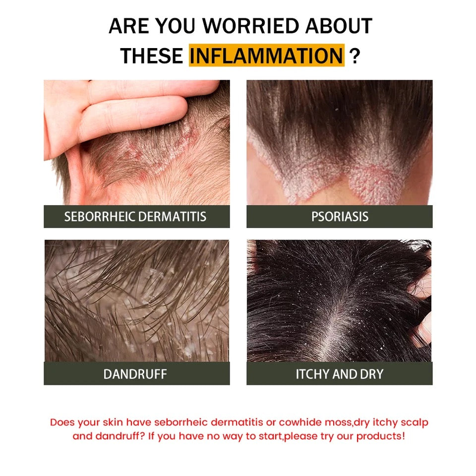 Seborrheic Dermatitis Cream | Herbal Cream for Treating Dermatitis, Psoriasis, and Dandruff - Image 5