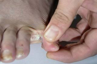 Foot Care Cream | Herbal Cream for Athlete's Foot, Itchy Feet and Foot Infections - Image 2